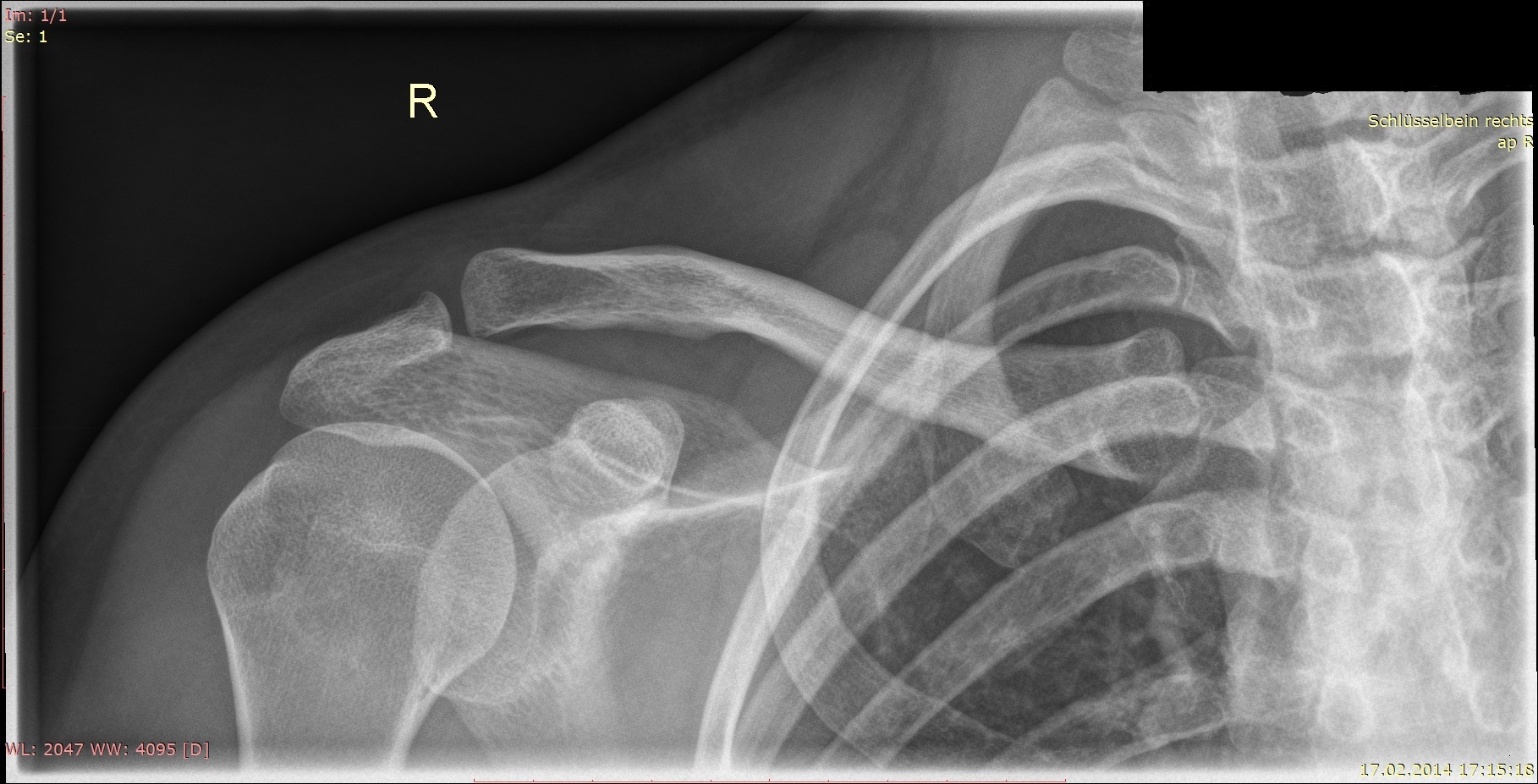 Schlüsselbein in Ordnung? (Schmerzen, Chirurgie, Radiologie)