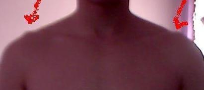 Schlusselbein Steht Weit Aus Oberkoerper Raus Knochen Anatomie Schlusselbein Steht Weit Aus Oberkoerper Raus Knochen Anatomie