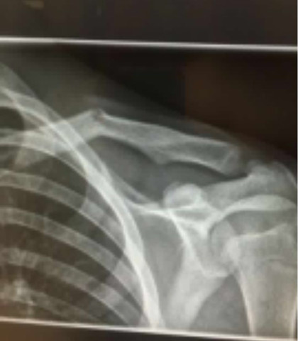 Schmerz In Der Schulter Nach Schlusselbeinbruch Schmerzen Schmerz In Der Schulter Nach Schlusselbeinbruch Schmerzen