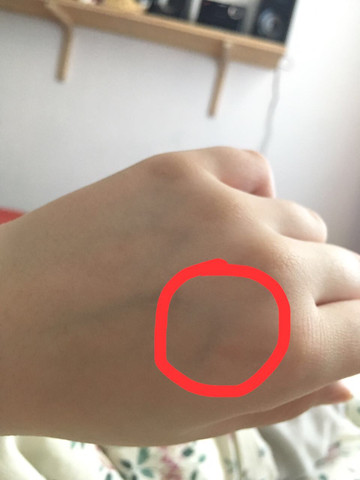 Schmerzen Ader Handrucken Arzt Schmerzen Ader Handrucken Arzt