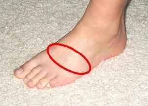 Schmerzen am Fuß (Bild)? (Füße)