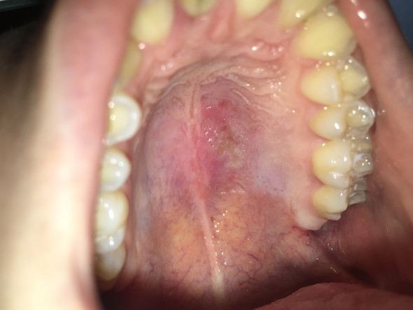 Gaumen Die Meistgelesenen Fragen Gaumen Die Meistgelesenen Fragen