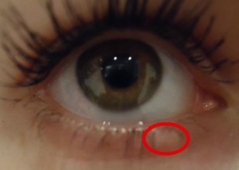 Schmerzen Am Untern Augenlid Bild Bilder Augen Schmerzen Am Untern Augenlid Bild Bilder Augen