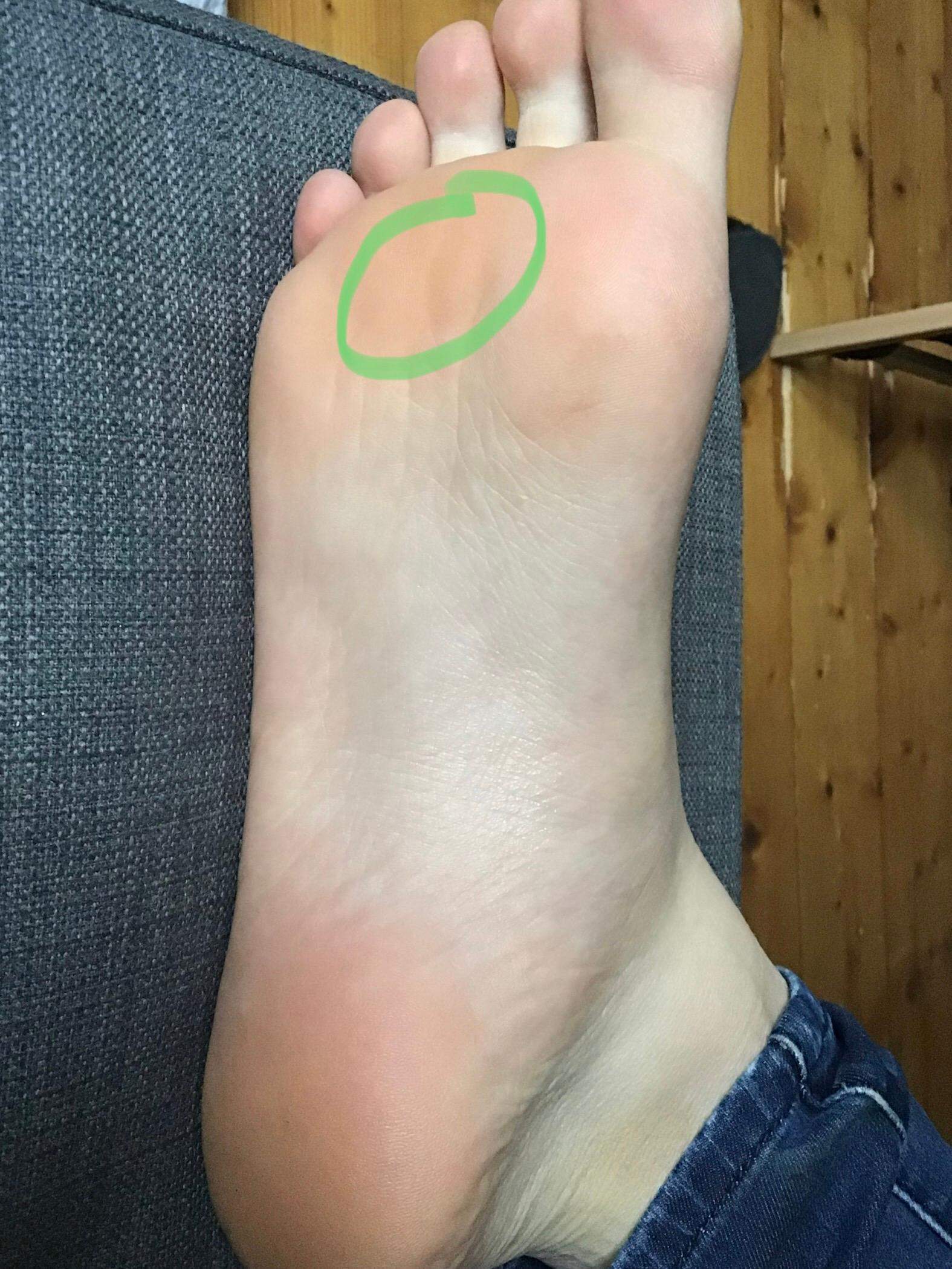 Schmerzen an der Fußsohle vorne? (Gesundheit und Medizin, Füße)