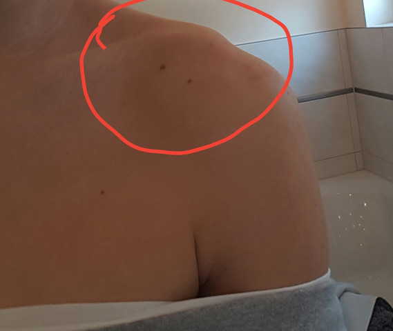 Schmerzen An Der Schulter Gesundheit Und Medizin Arzt Schulterschmerzen Schmerzen An Der Schulter Gesundheit Und Medizin Arzt Schulterschmerzen