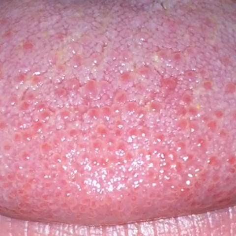 Schmerzen An Zungenspitze Zunge Blaeschen Schmerzen An Zungenspitze Zunge Blaeschen