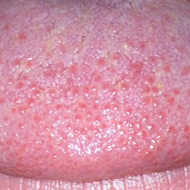 Schmerzen an Zungenspitze? (Zunge, blaeschen)