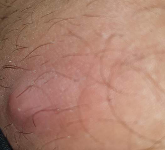 Schmerzen Bei Bewegung Durch Diesen Komischen Ding Auf Mein Oberschenkel Gesundheit Und Medizin Gesundheit Krankheit Schmerzen Bei Bewegung Durch Diesen Komischen Ding Auf Mein Oberschenkel Gesundheit Und Medizin Gesundheit Krankheit