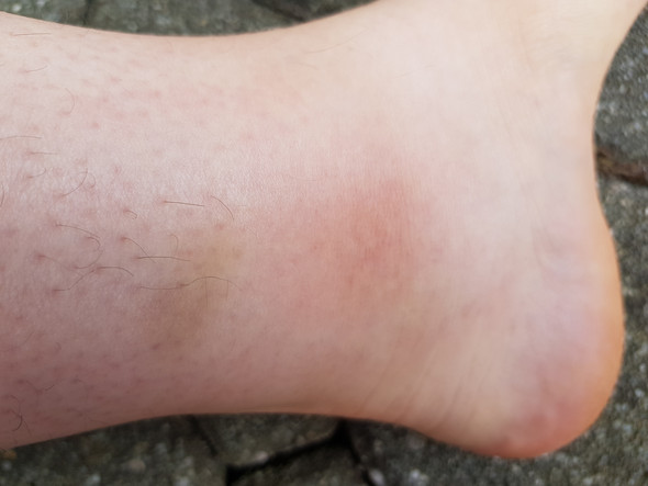 Schmerzen Fuss Angeschwollen Gesundheit Und Medizin Sprunggelenk Banderriss