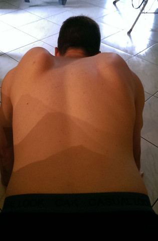 Schmerzen Im Arm Jetzt Steht Schulterblatt Hervor Orthopadie Schulter Schmerzen Im Arm Jetzt Steht Schulterblatt Hervor Orthopadie Schulter