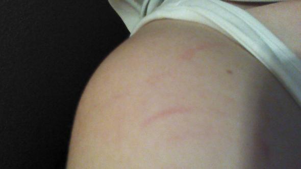 Schmerzen Im Arm Und Kratzer Medizin Arzt Muskelkater Schmerzen Im Arm Und Kratzer Medizin Arzt Muskelkater