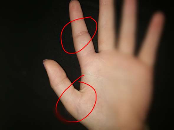 Schmerzen Im Daumen Und Zeigefinger Gesundheit Und Medizin Arzt Hand Schmerzen Im Daumen Und Zeigefinger Gesundheit Und Medizin Arzt Hand