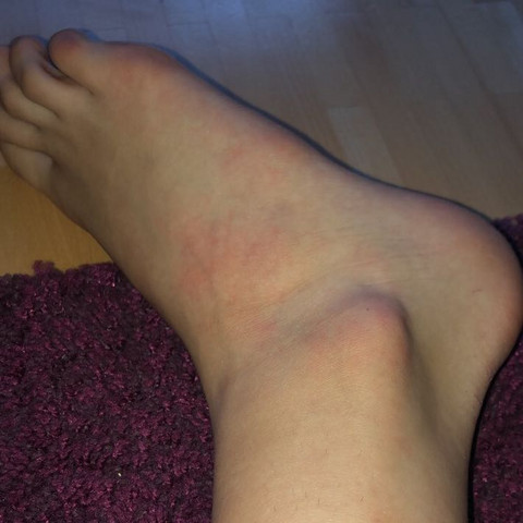 Schmerzen Im Fussgelenk Weil Gerade Umgeknickt Gesundheit Und Medizin Medizin Sport Und Fitness