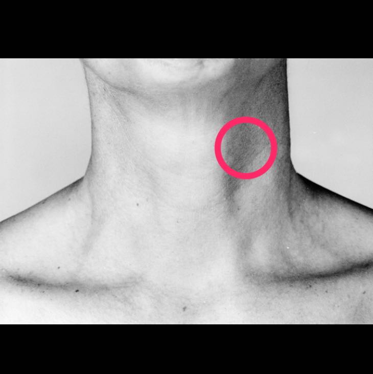 Schmerzen im Hals auf der linken Seite beim Schlucken? (Gesundheit ...