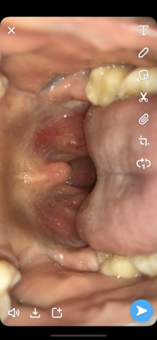 Schmerzen Im Hals Vorallem Beim Schlucken Halsschmerzen Schmerzen Im Hals Vorallem Beim Schlucken Halsschmerzen