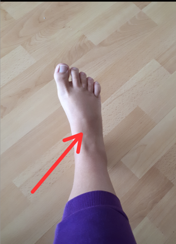 Schmerzen im Mittelfußknochen