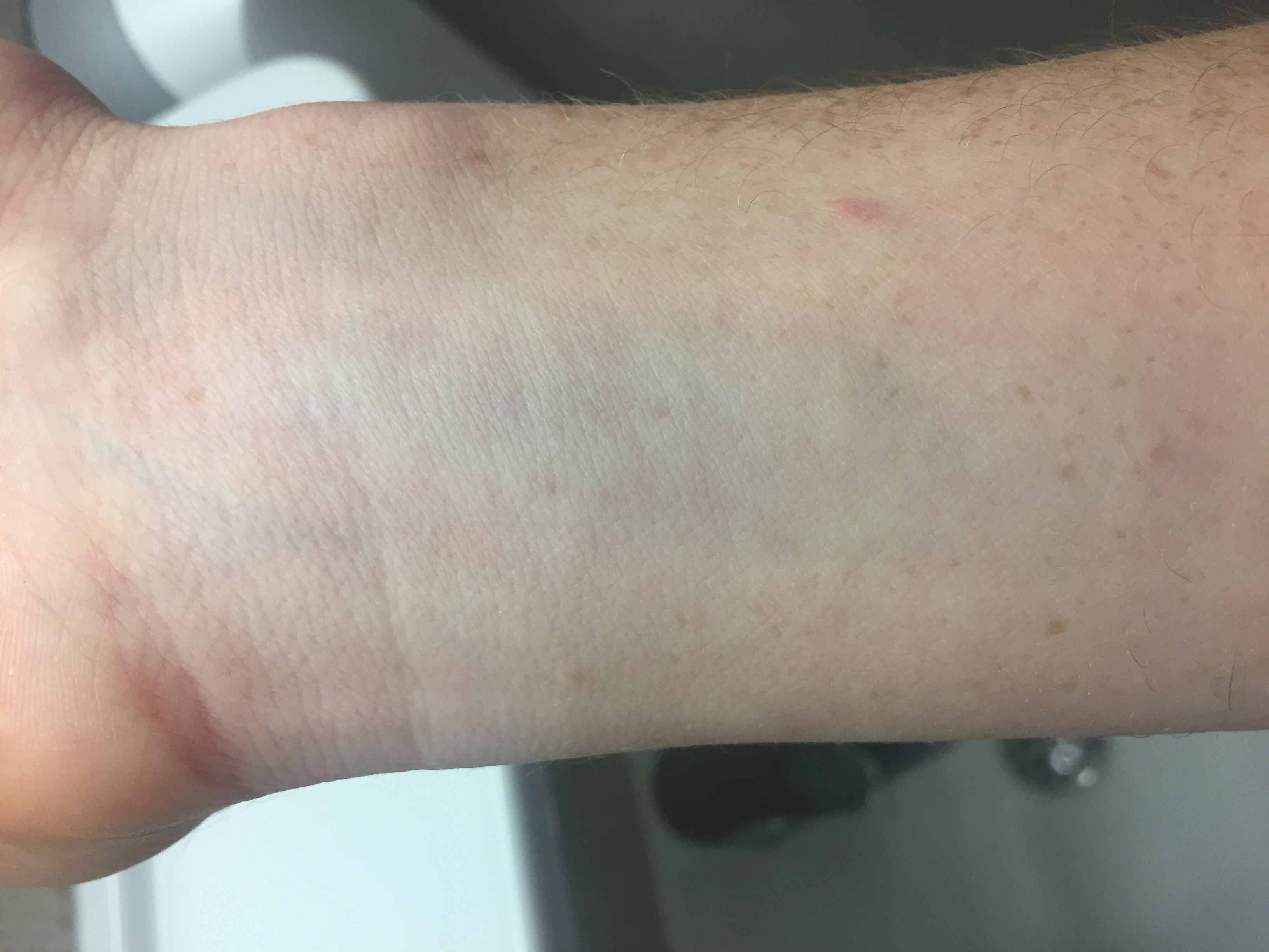 Trombose Im Arm Erythema nodosum (Knotenrose) Apotheken Umschau Trombose Im Arm Erythema nodosum (Knotenrose) Apotheken Umschau