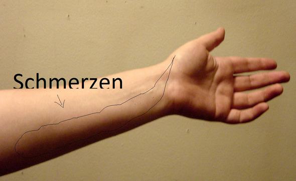 Schmerzen Im Unterarm Gesundheit Sport Arzt Schmerzen Im Unterarm Gesundheit Sport Arzt
