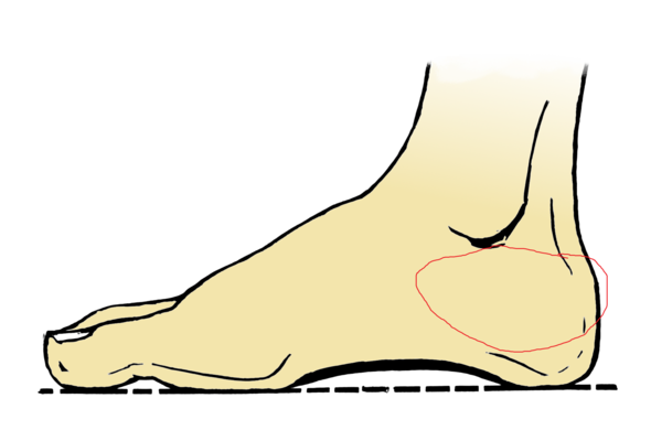 Darstellung des Schmerzortes - (Füße, Fußschmerzen, Ferse)