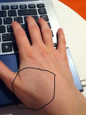 - (Arzt, Schmerzen, Hand)