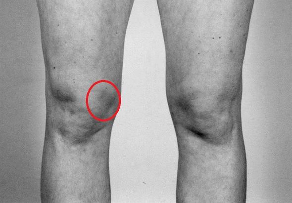 Schmerzen In Knie Innenseite Schmerzen In Knie Innenseite