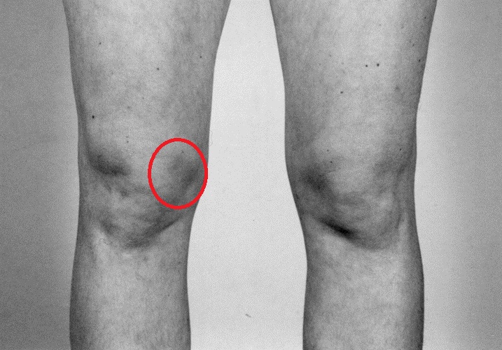 Schmerzen in Knie Innenseite