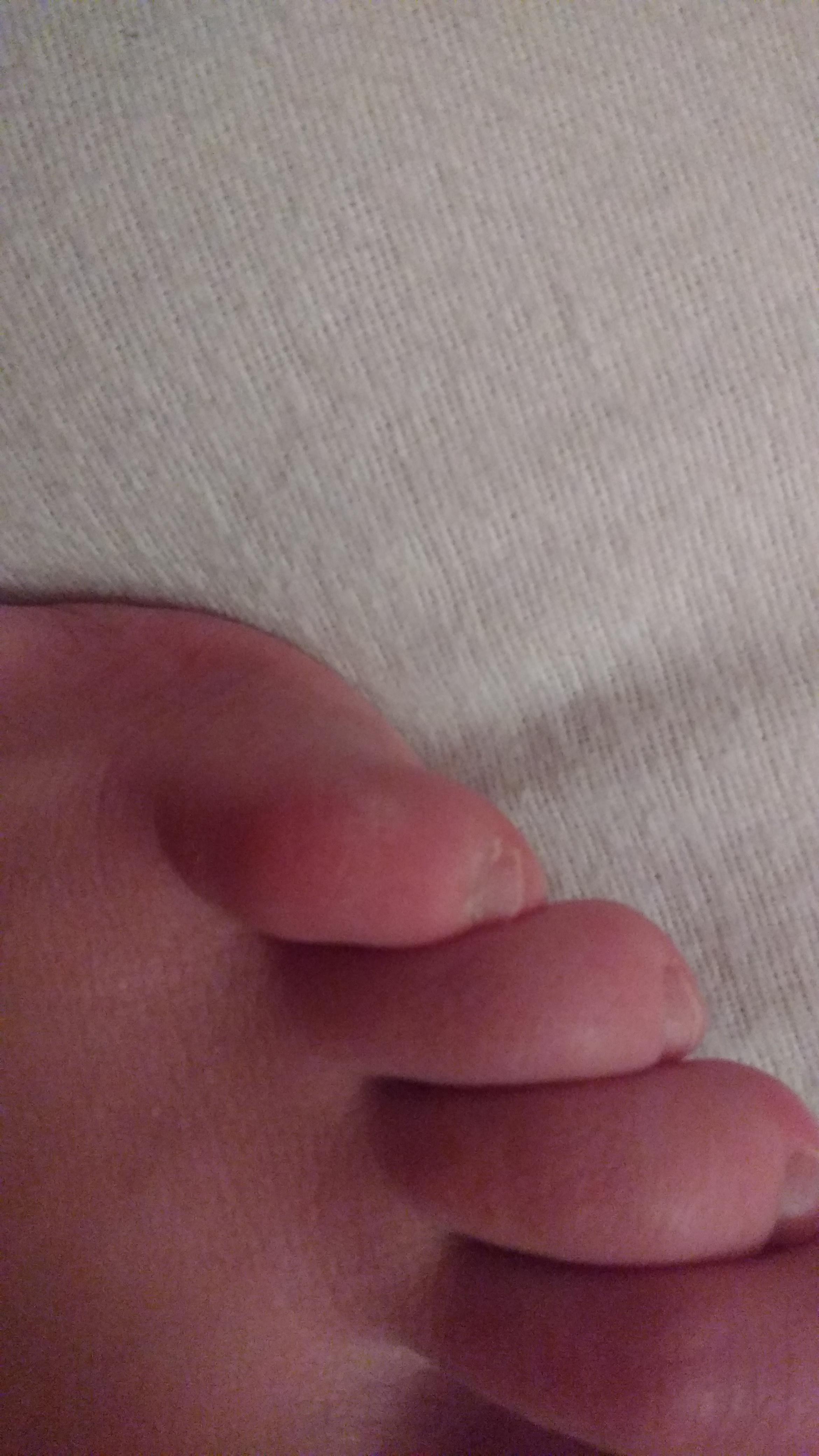 Schmerzen Kleiner Zeh Korper Fusse Schmerzen Kleiner Zeh Korper Fusse