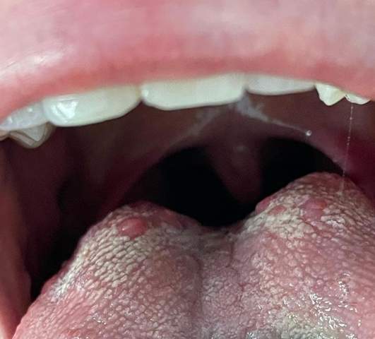 Schmerzen und Belag auf der Zunge?