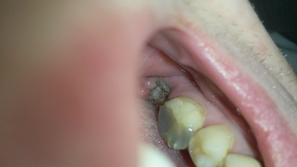 Kieferknochenentzündung nach zahn ziehen