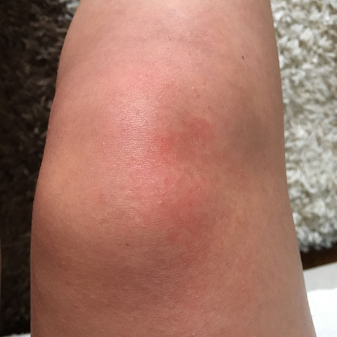 Knie nach Minigolf - (Schmerzen, Knie)