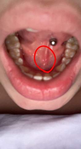 Zungenpiercing schmerzen unter der zunge