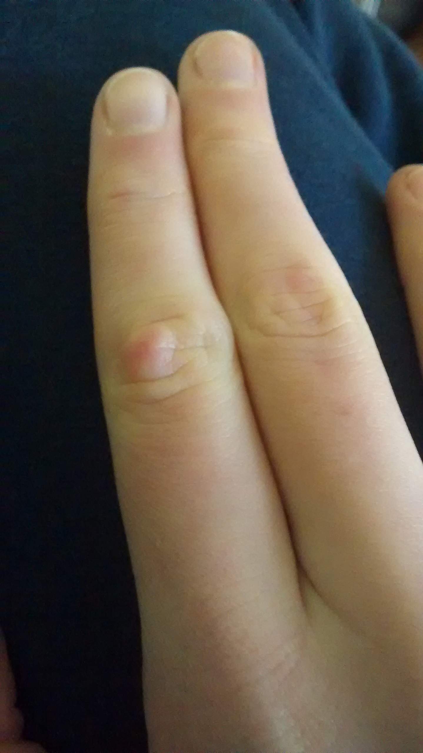 schmerzende Hubbel an den Fingern. iw Erfahrungen?