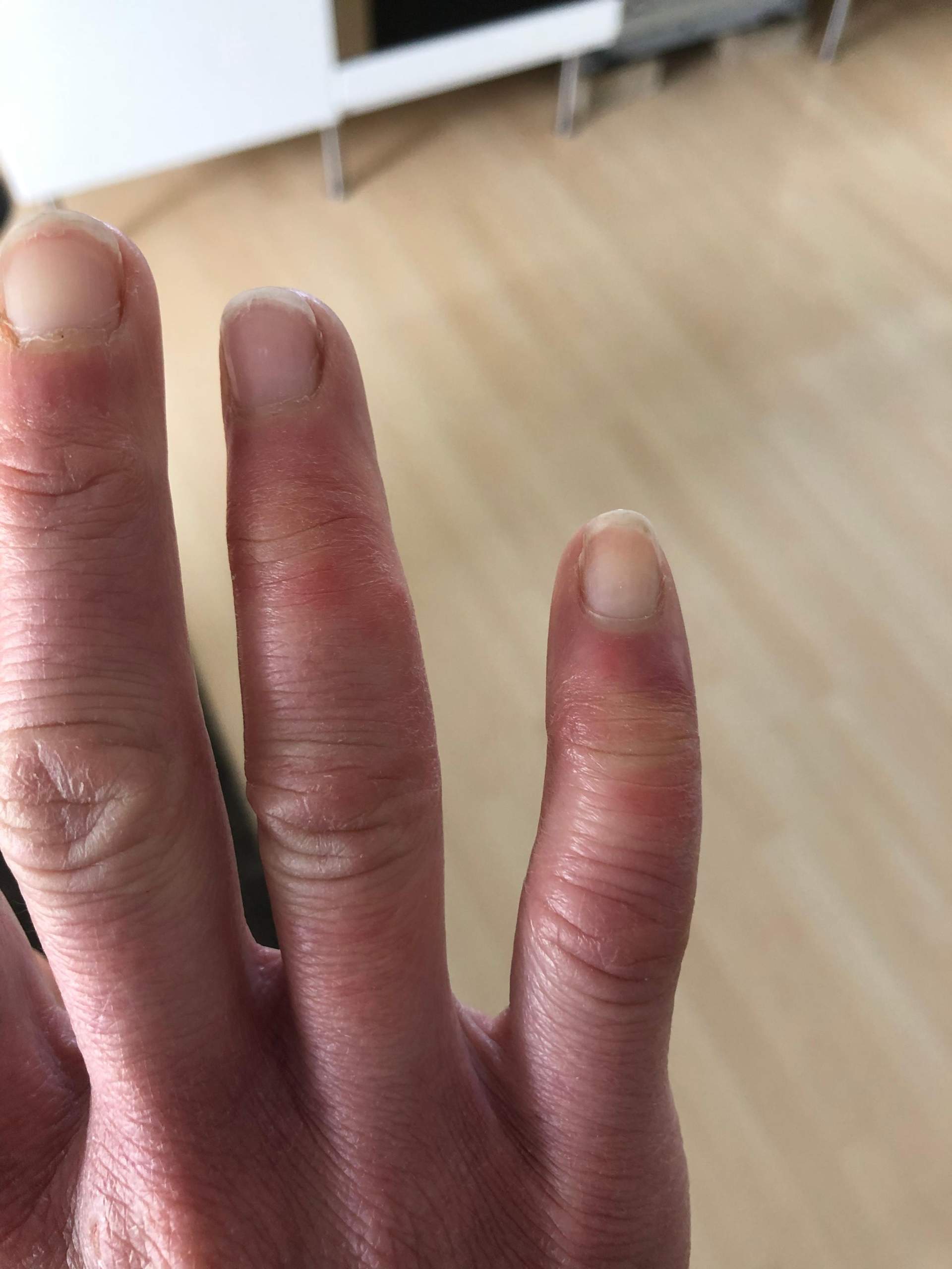 Schmerzende und bei Wärme juckende Schwellung an Fingern, Gicht wurde ausgeschlossen, was ist es Schmerzende und bei Wärme juckende Schwellung an Fingern, Gicht wurde ausgeschlossen, was ist es