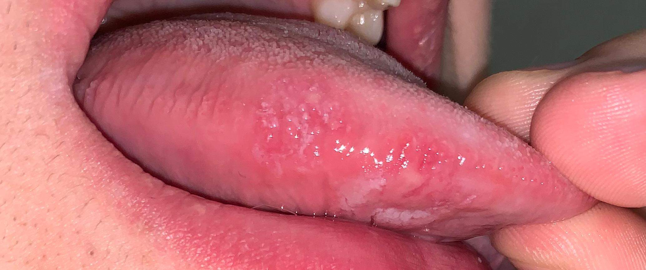 Schmerzende Wunde An Der Zunge Was Ist Das Schmerzende Wunde An Der Zunge Was Ist Das