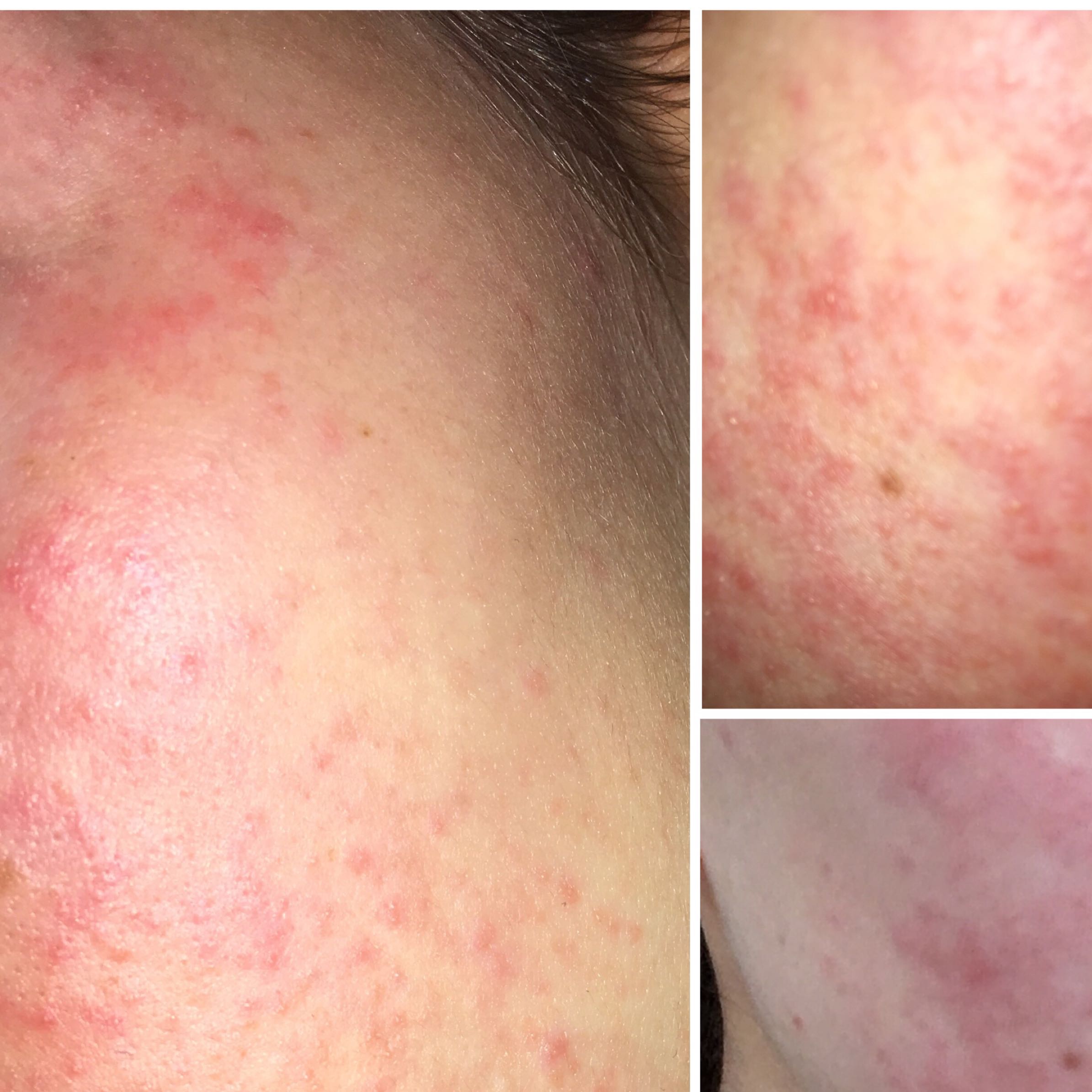 Schmerzender Hautausschlag im Gesicht? (Gesundheit und Medizin