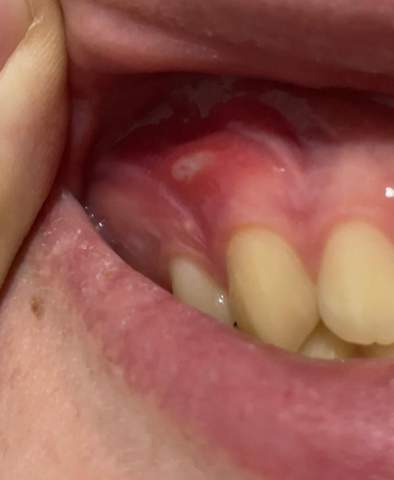 Schmerzender Weißer Punkt auf Zahnfleisch?