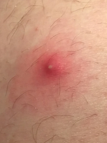 Schmerzhafte Entzundung Am Oberschenkel Sollte Man Das Behandeln Medizin Haut