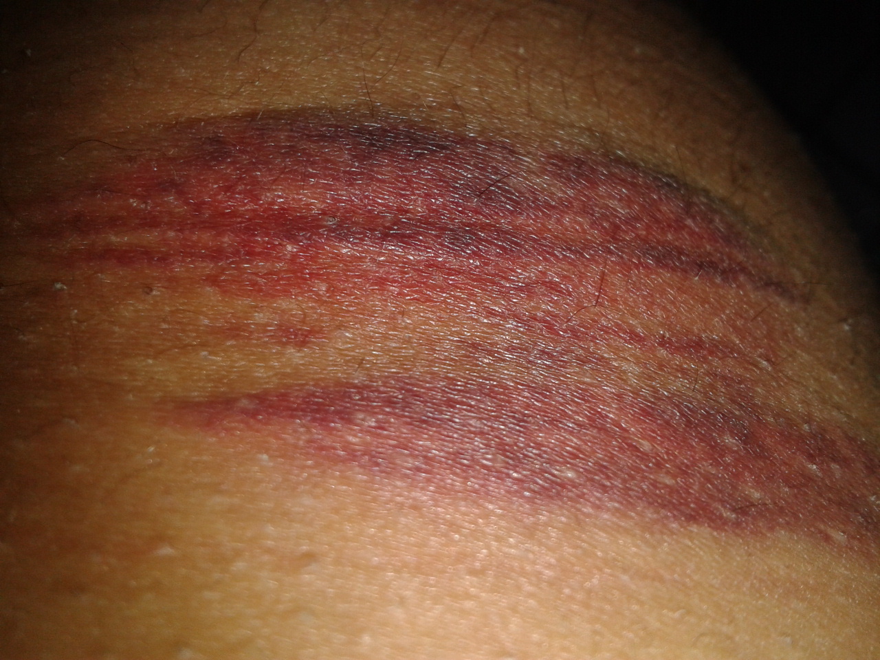 blauer fleck nach blutabnahme - DrBeckmann