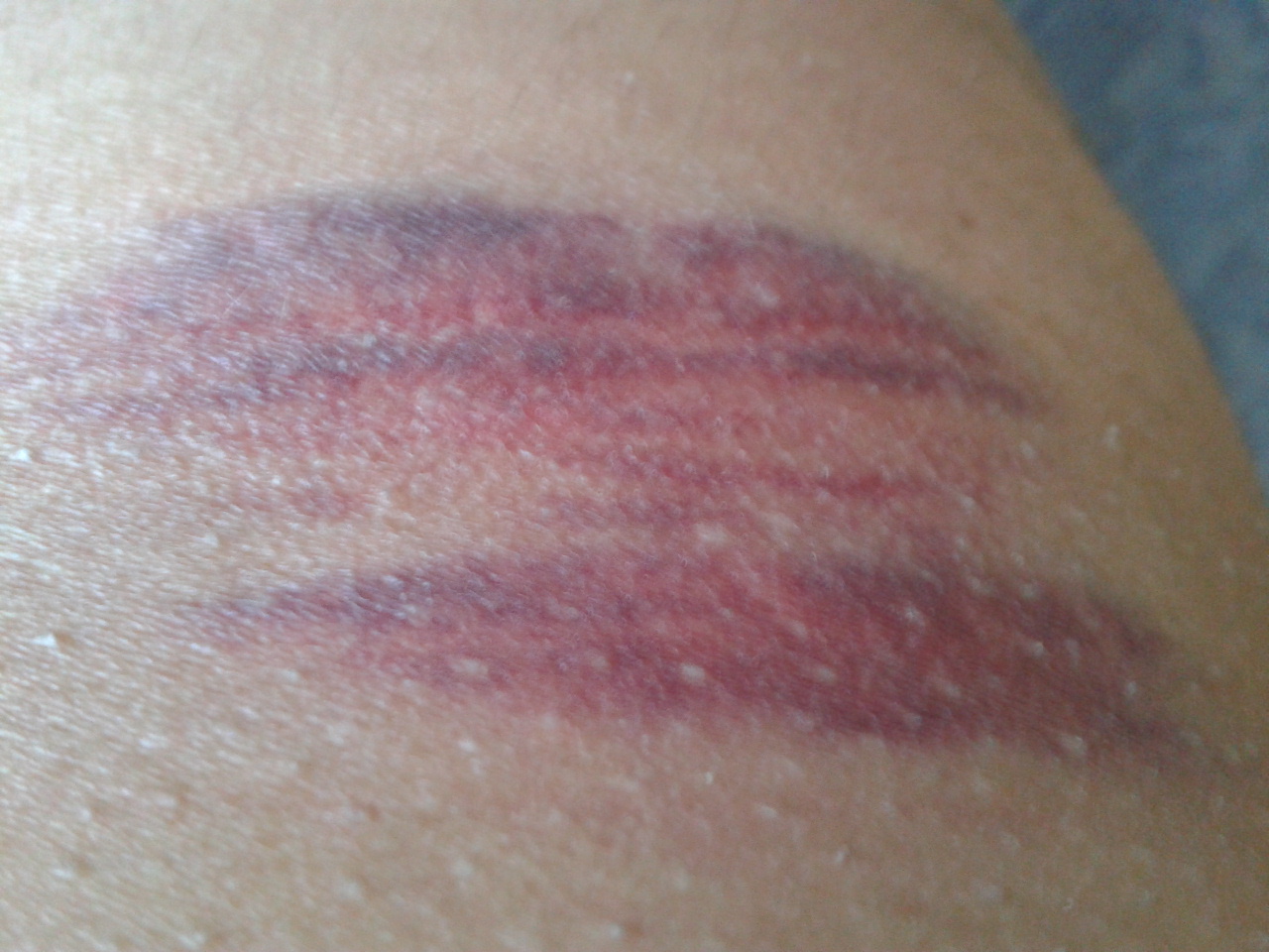 blauer fleck nach blutabnahme - DrBeckmann