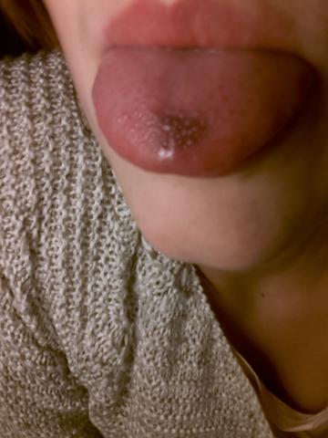 Schmerzhafter Dunkler Punkt Auf Zunge Schmerzen Schmerzhafter Dunkler Punkt Auf Zunge Schmerzen