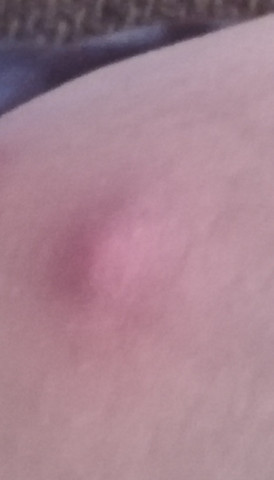 Schmerzhafter Grosser Pickel Zwischen Den Beinen Rechts Bild Was Kann Ich Dagegen Tun Gesundheit Und Medizin Beine Intim Schmerzhafter Grosser Pickel Zwischen Den Beinen Rechts Bild Was Kann Ich Dagegen Tun Gesundheit Und Medizin Beine Intim