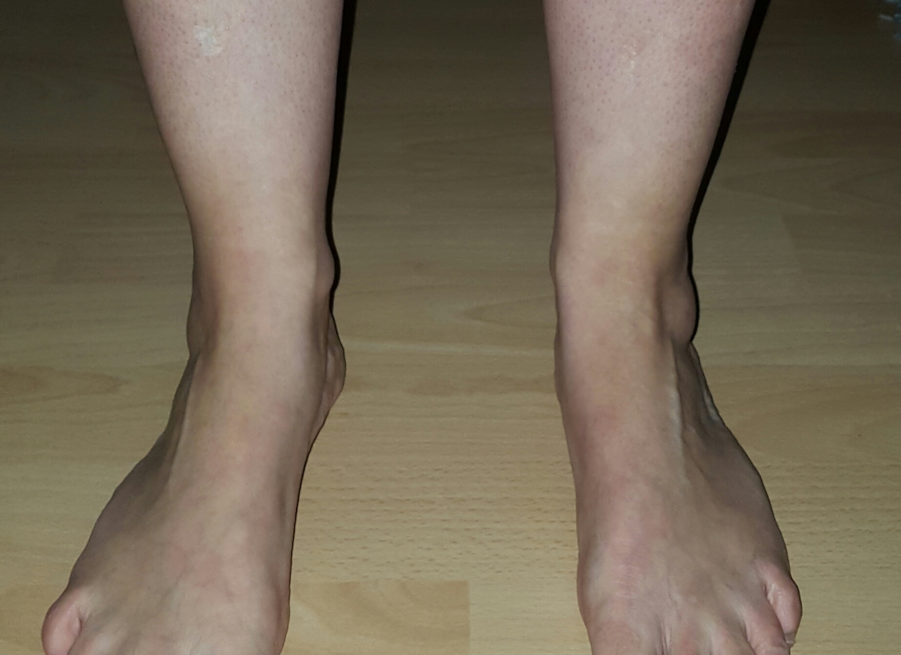 Schmerzlose Schwellung am linken Knöchel? (Gesundheit, Körper)