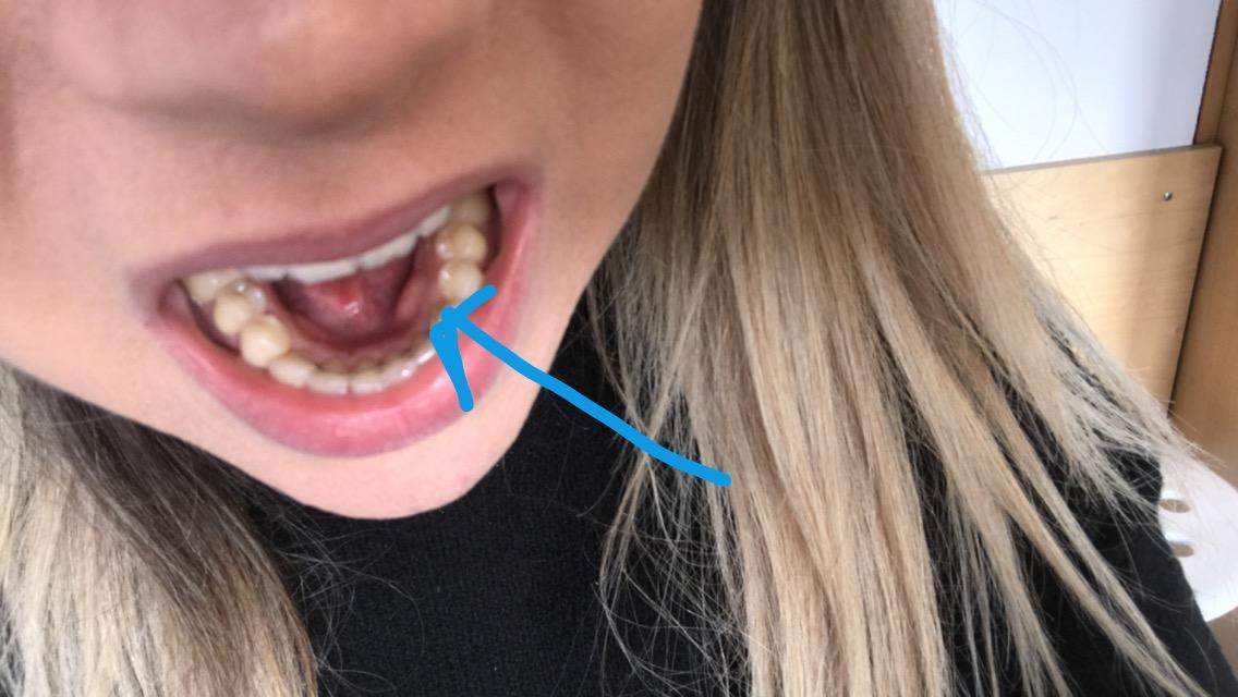 Schmerzlose Schwellung am Zahnfleisch? (Gesundheit und Medizin, Zähne) Schmerzlose Schwellung am Zahnfleisch? (Gesundheit und Medizin, Zähne)