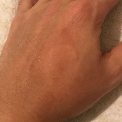 Schmerztablette Nebenwirkungen Allergisch Zbp Paracertamol Ibuprofen Allergie Paracetamol Schmerztabletten Schmerztablette Nebenwirkungen Allergisch Zbp Paracertamol Ibuprofen Allergie Paracetamol Schmerztabletten