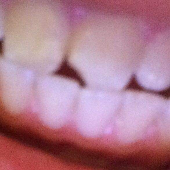 Zahn vom kleines abgebrochen stück Kleines Stück