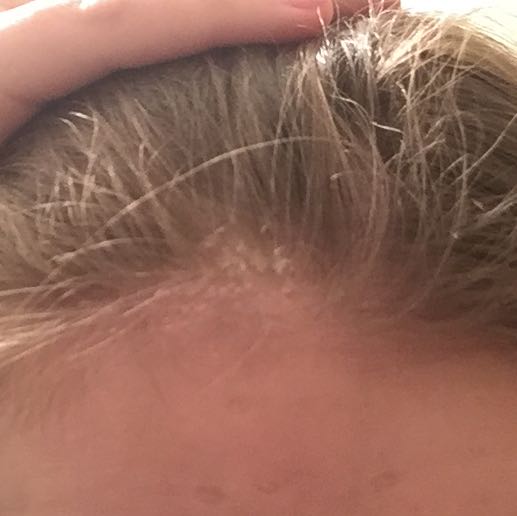 Schnelle Hilfe gesucht bei trockener kopfhaut? (Shampoo, trocken, Schuppen)