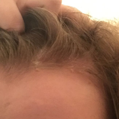 shampoo trocken schuppen