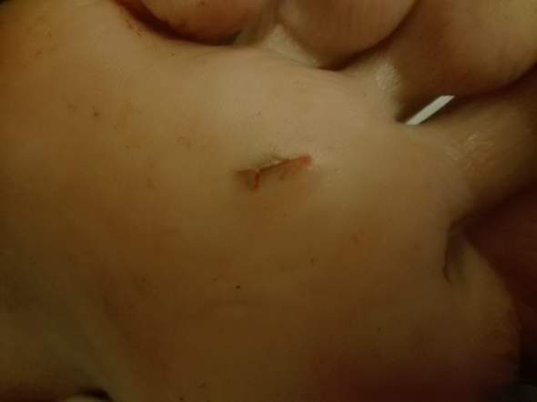 Schnittwunde Am Fuss Zum Arzt Gehen Gesundheit Und Medizin Wunde Schnittwunde Am Fuss Zum Arzt Gehen Gesundheit Und Medizin Wunde