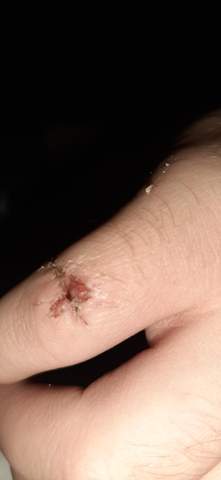 Schnittwunde Heilung Am Finger Schnittwunde Heilung Am Finger