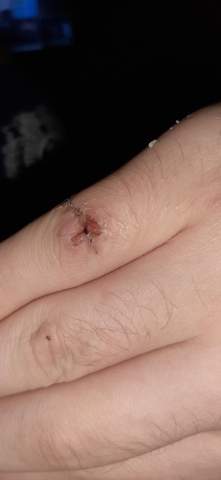 Schnittwunde Heilung Am Finger Schnittwunde Heilung Am Finger